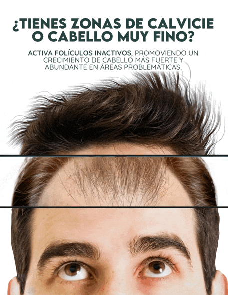 OUHOE HAIR™ - SUERO PARA EL CRECIMIENTO DEL CABELLO 🌿🧔